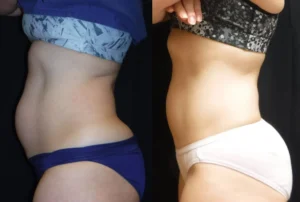 Body Sculpting in Wilmington, NC