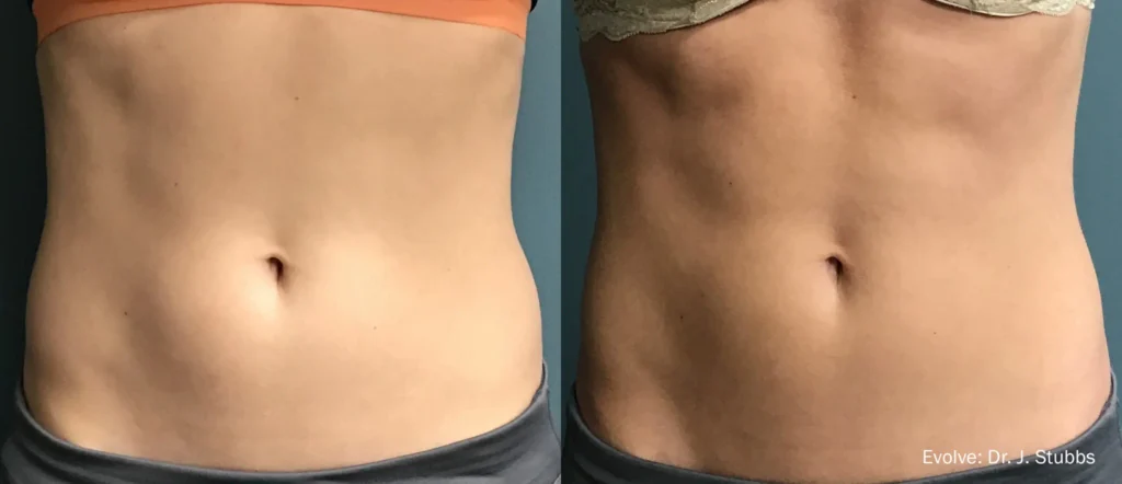 body sculpting in wilmington nc