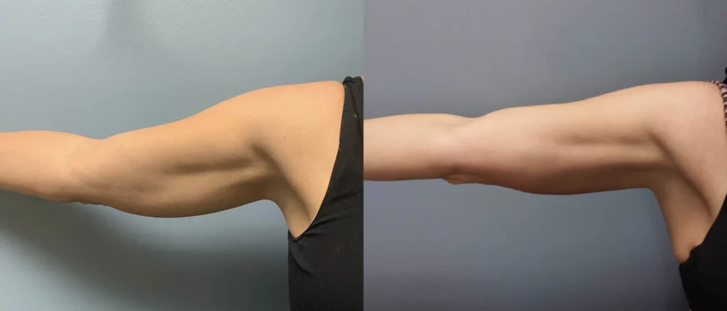 evolve x Body Sculpting in Wilmington, NC