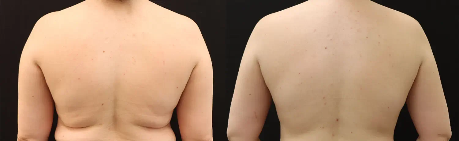 Body Sculpting in Wilmington, NC